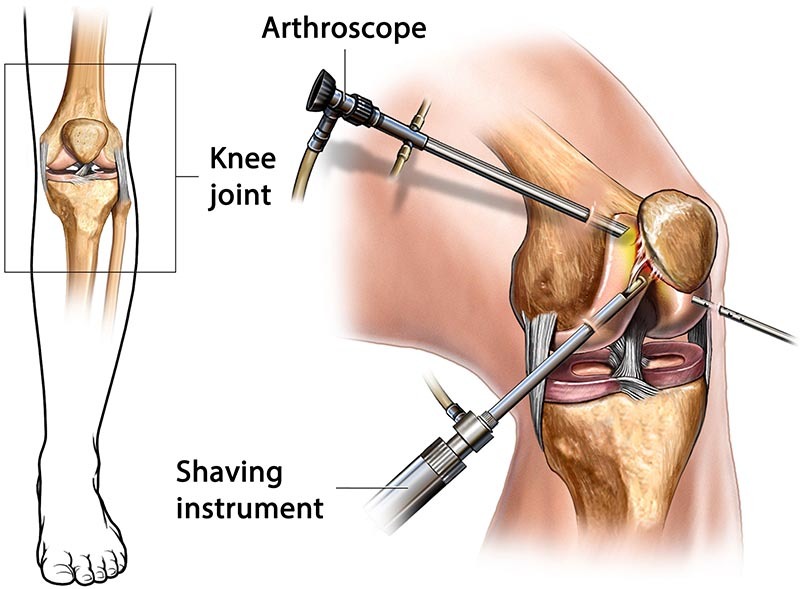 Arthroscopy