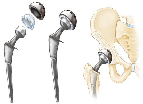 Hip Replacement Surgery